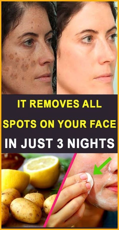 Well Health Organic Best Ways to Remove Dark Spots on Face